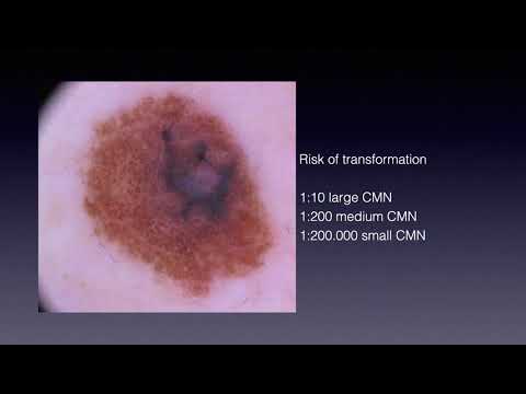 Melanoma in congenital nevi - Dr. Giuseppe Argenziano