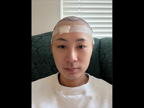 FUE植髮 ｜男生植髮｜植髮後的當天｜Hair Restoration｜Hair Transplant