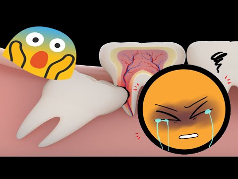 حكاية ايوم مع ضرس العقل 🦷🤕 ~story of my life~