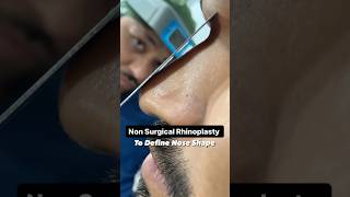 Non Surgical Rhinoplasty : To Define Nose Shape !  #nonsurgicalrhinoplasty