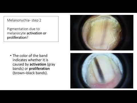 Pigmented Nail Lesions - Dr. M .Buljan