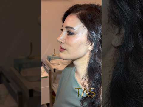 She had 2 failed facelift with someone else and she is a wife of plastic surgeon. #drsuleymantas