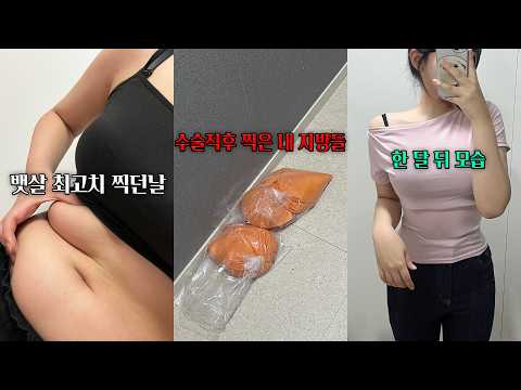 첫 복부지방흡입 했는데... 상상초월사태 발생 [동은Vlog]