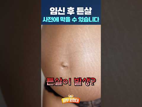 임산부 튼살!! 미리 알고 있으면 예방가능합니다!! #shorts #튼살 #임산부