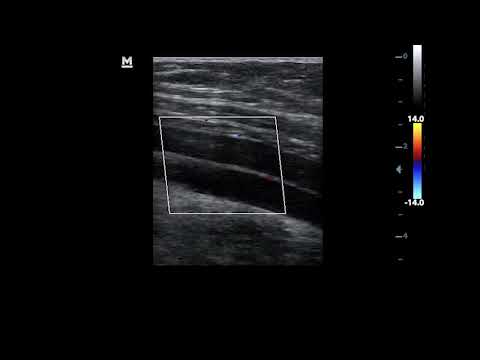 Double femoral vein with one of them presenting with short reflux