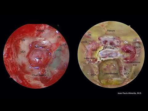 Endoscopic endonasal pituitary hemitransposition for resection of supra- & retrosellar dermoid cyst