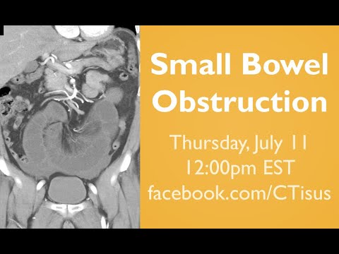 Facebook Live: Small Bowel Obstruction (SBO)