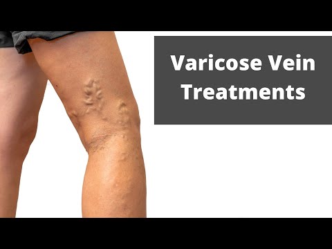 Treatment for Varicose Veins