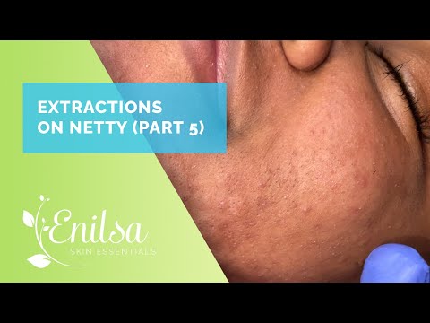 Blackhead Extractions on Netty - Fifth Treatment