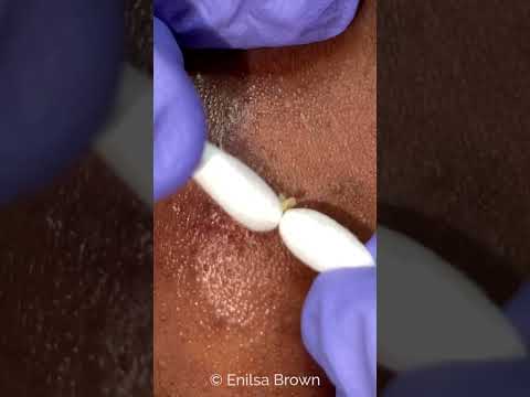 Extractions on Emily ⚡️Short Video⚡️