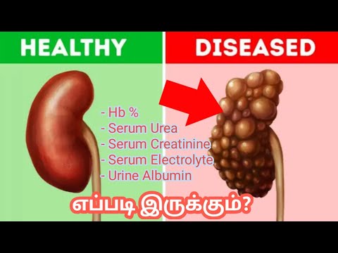 Normal kidney vs diseased kidney/kidney pain location on body in tamil/kidney pain symptoms in tamil