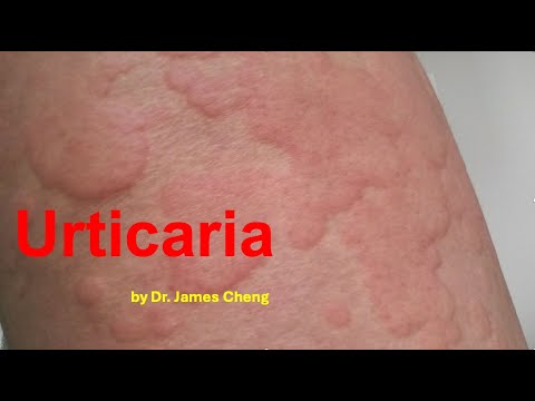 Urticaria by Dr. James Cheng