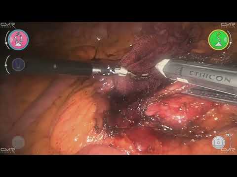 Robotic oncologic Right Colectomy with a new robotic platform (CMR Versius)