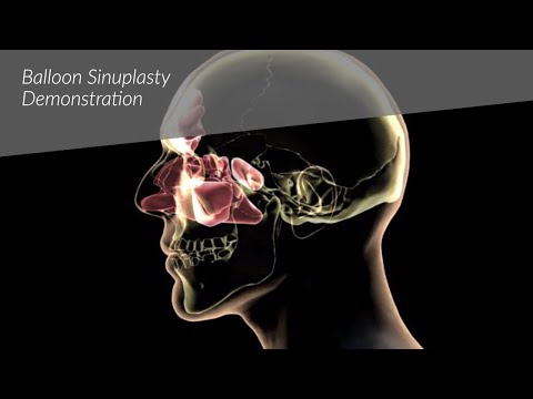 Balloon Sinuplasty Demonstration