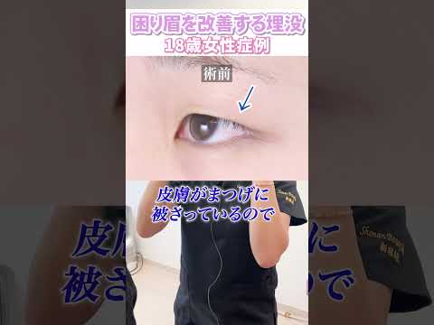 【18歳女性】困り眉を二重埋没で改善！#shorts