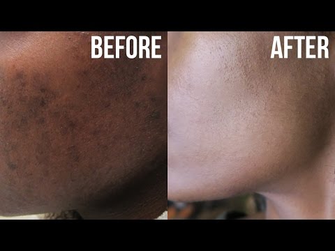 Get Rid of Acne &  Hyperpigmentation (Dark Spots)