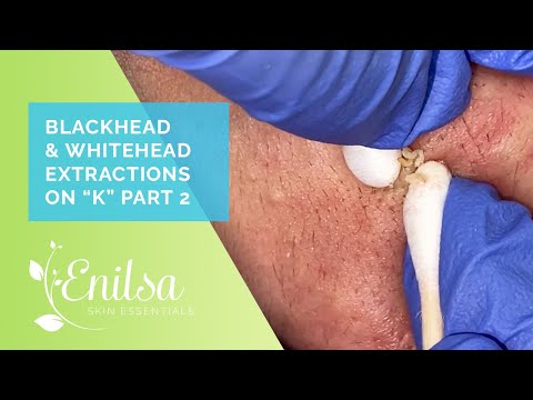 Blackhead & Whitehead Extractions on "K" - Part 2