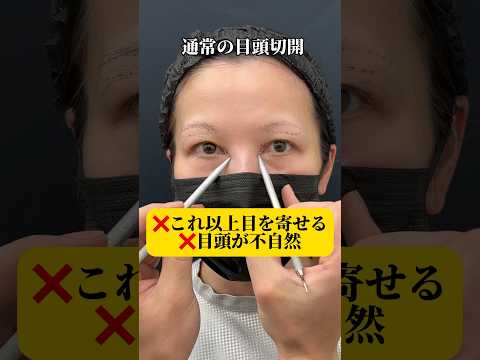 寄り目になりたくない！50代女性、目上リフトで可愛く若返り☆#目上切開 #目上リフト #眉下切開