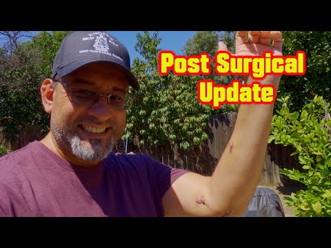 Hernia Surgery Update | Wicked Journey Vlog Aug 2023