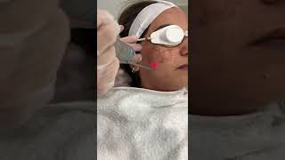 Q-Switched Laser Toning (pigmentation removal)