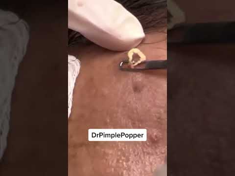 A Win is a Win! Dr Pimple Popper ForeheadPop