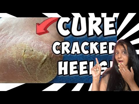 How to get soft  heels overnight|Cracked heels treatment|Painful cracked heels|Auro's Beauty Care