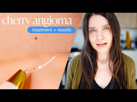 How to Get Rid of Cherry Angiomas Moles (Red Skin Dots) | PLASMA PEN REMOVAL REVIEW + DEMO + RESULTS