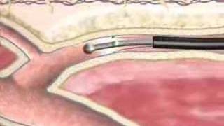 Varicose Veins Closure Procedure at BIDMC