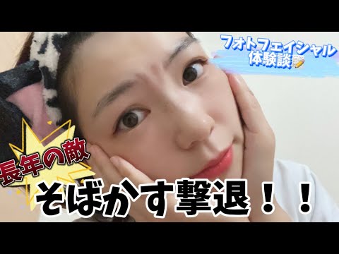 【シミ治療】フォトフェイシャルでシミを撃退できるのか試してきた！