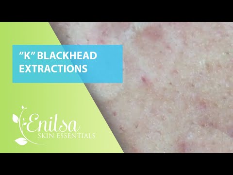 Blackheads Extractions “K’s” 6th Treatment