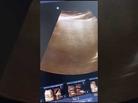 Pain in epigastric Region #health #ultrasound #science