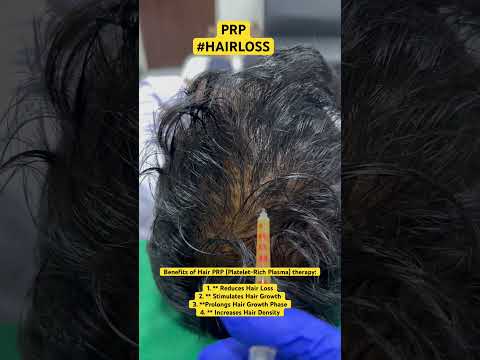 Hair PRP for Hair Loss | Platelet-Rich-Plasma Treatment #shorts #ytshorts