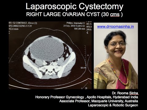 LARGE OVARIAN CYST -30cms-Laparoscopic Ovarian cystectomy DrRooma Sinha Apollo Hospitals,Hyderabad