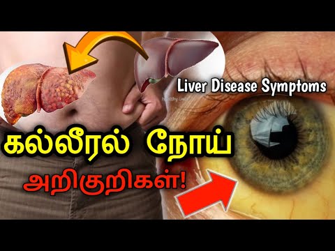 இந்த நோய் அறிகுறிகள் இருந்தால் அவதானம் | Beware of these symptoms | Liver problem symptoms in tamil