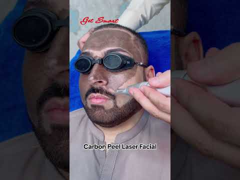 Carbon Peel Laser Treatment #getsmarthairclub