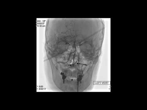 Surgical treatment of previously embolized craniocervical junction dural arteriovenous fistula