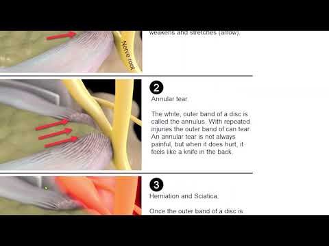 How discs bulge, tear, herniate and then irritates a nerve root to cause sciatica | Best Practice