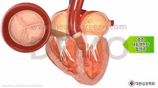 [시연용] c0251abko_[대한심장학회] 경피적 대동맥판막치환술(TAVI)안내(요약판)