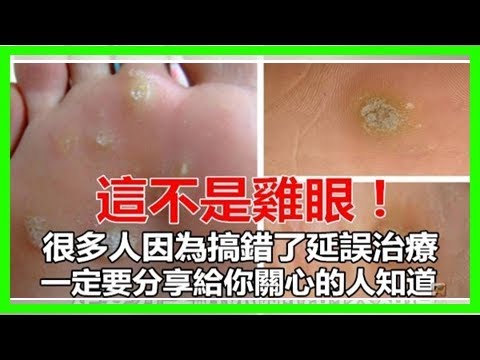 驚！這不是雞眼竟是一種瘤，別搞錯，延誤治療！