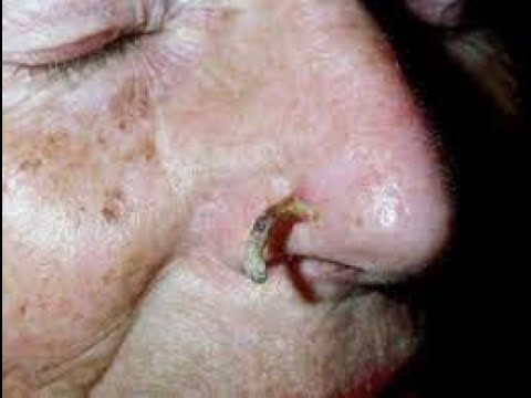 blackheads new this week