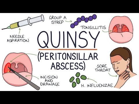 Understanding Quinsy (Peritonsillar Abscess)