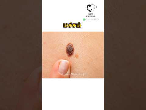 Are Moles dangerous? மச்சம் பற்றிய உண்மைகள்- Dr. Isacc Abbas