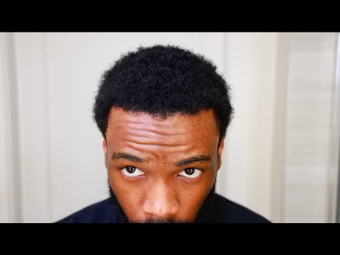 Hair Transplant Month 8