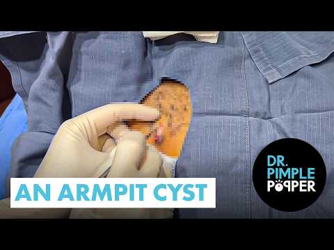 An Armpit Cyst