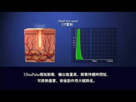 傳統二氧化碳雷射與UP雷射 的不同