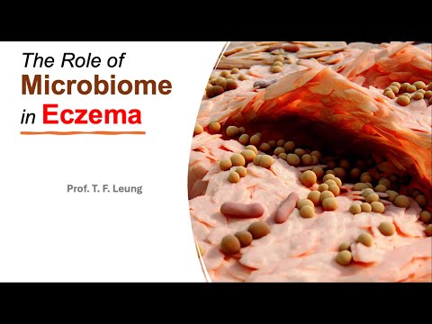 What are the roles of Microbiome in Eczema?  by Prof. T. F. Leung (2 July 2024)