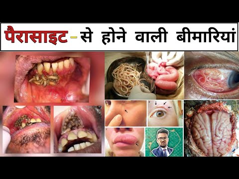 Parasitic Infections | Infection | Treatment | Doctor | Hospital | Medical | Pharmacy | Nursing