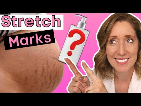 How to Fade Stretch Marks | Proven Tips for Stretch Mark Treatments