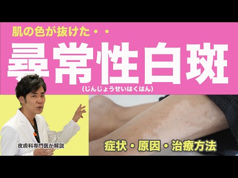 あの有名女優も・・尋常性白斑