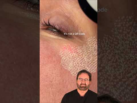 Fractional CO2 Laser Treatment Surgeon Reacts